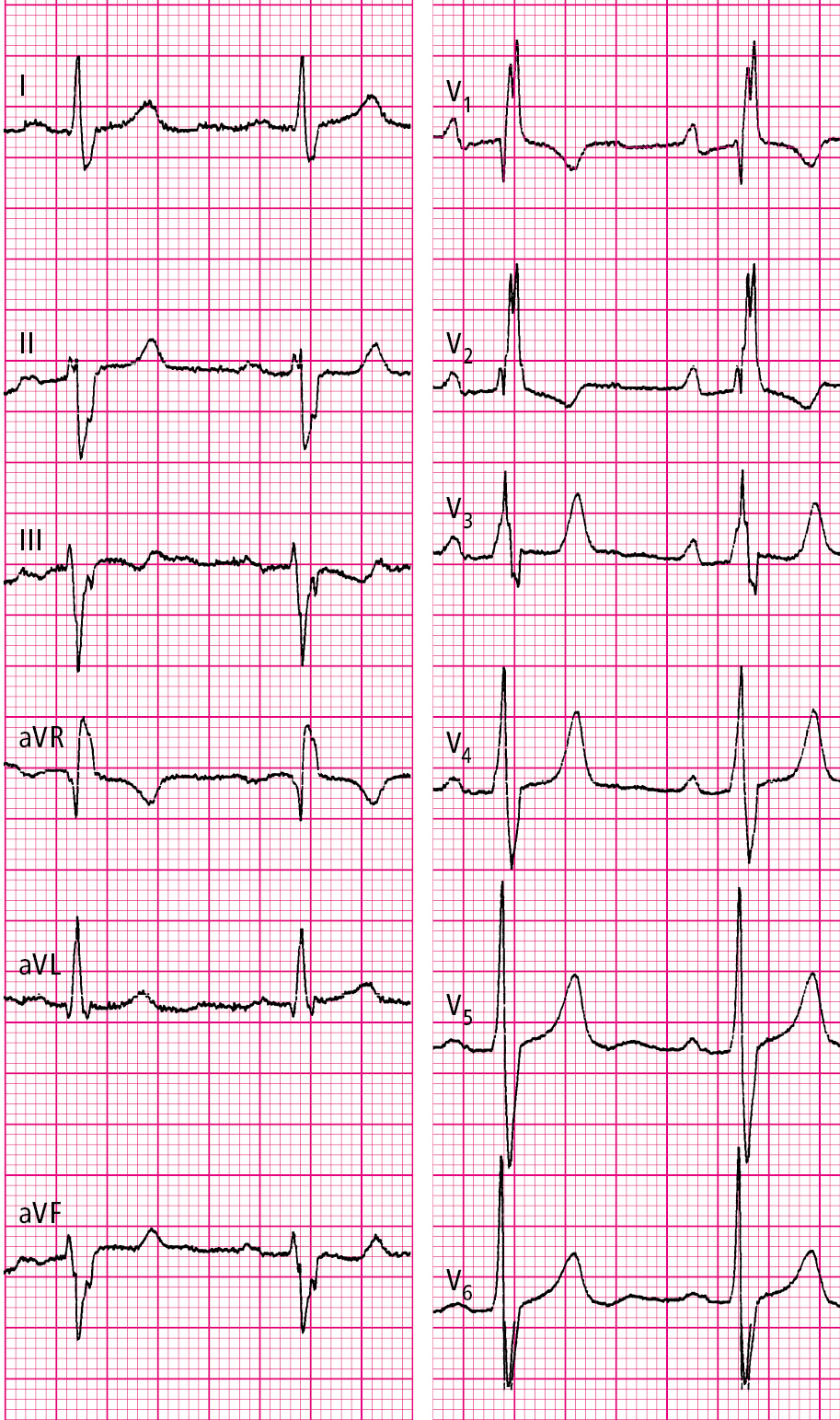Figure 031_3053.  Electrocardiography (ECG) of a patient with atrial septal defect (ASD) type I: normal sinus rhythm, 69 beats/min, left axis deviation, right bundle branch block (RBBB), features of right ventricular hypertrophy. 