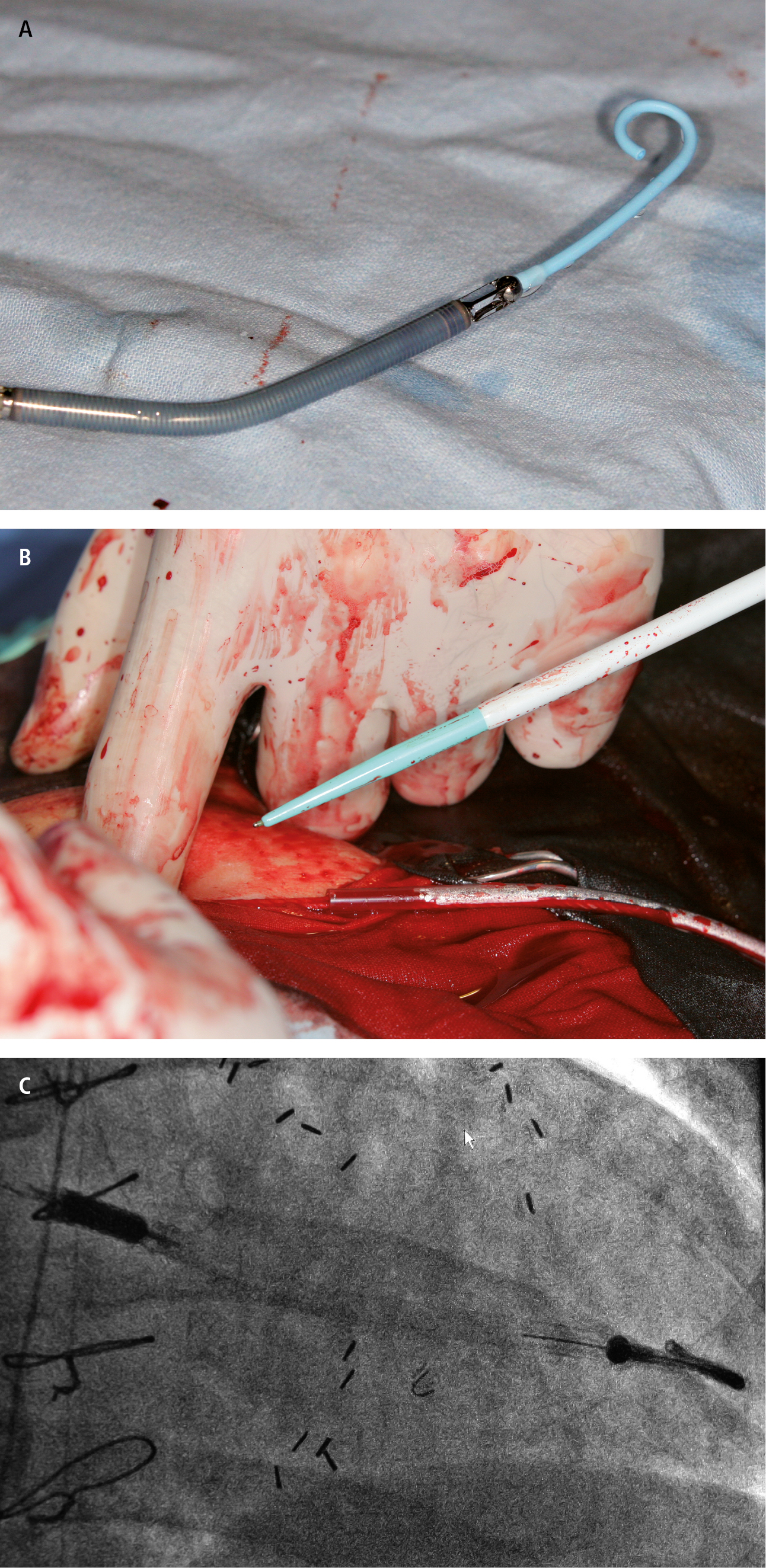 Figure 031_3092.  
Implantation of a mechanical circulatory support system (Impella) through vascular access.  A , miniaturized system before implantation.  B , system implantation via the femoral artery.  C , correctly positioned device. 