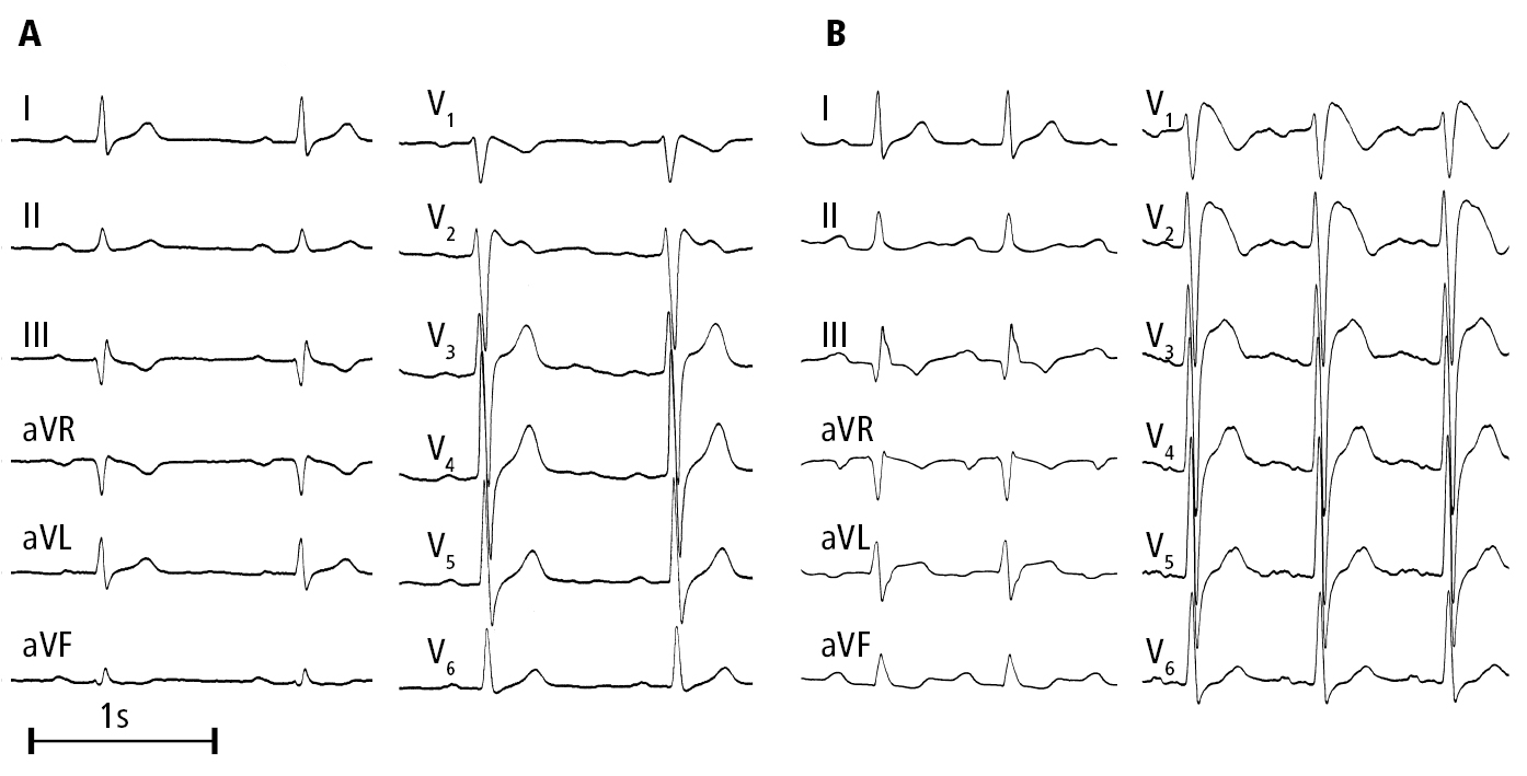 Figure 031_3136.  Electrocardiography (ECG) of a patient with Brugada syndrome:   A  , nearly undetectable changes;   B  , a typical ECG pattern 9 days later.  Figure courtesy of Dr Andrzej Stanke.  