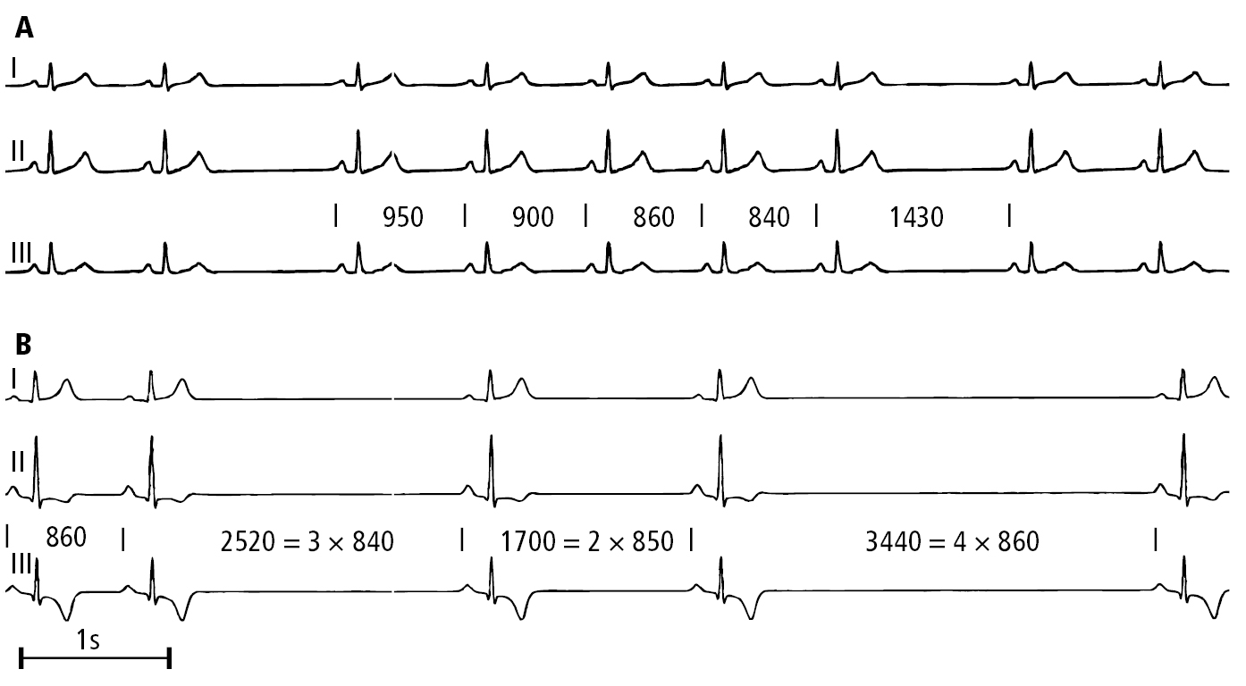 Figure 031_3152.  Electrocardiography (ECG) of a patient with sinus node dysfunction:  A , second-degree sinoatrial block, Mobitz type I (Wenckebach);  B , advanced second-degree sinoatrial block.  Figure courtesy of Dr Andrzej Stanke.  