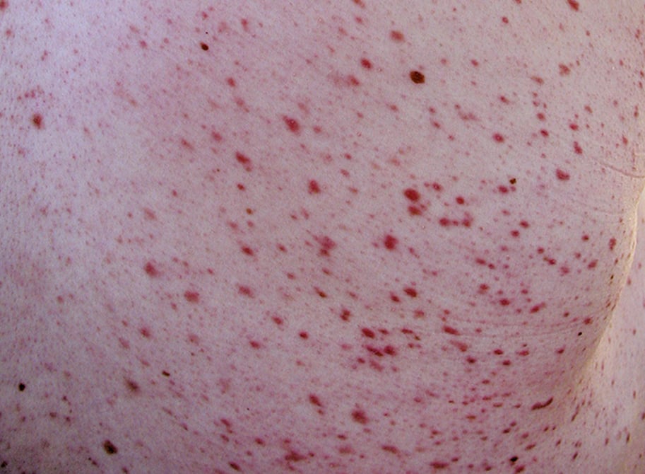 Figure 031_3195.  Mastocytosis: macules on the back. 