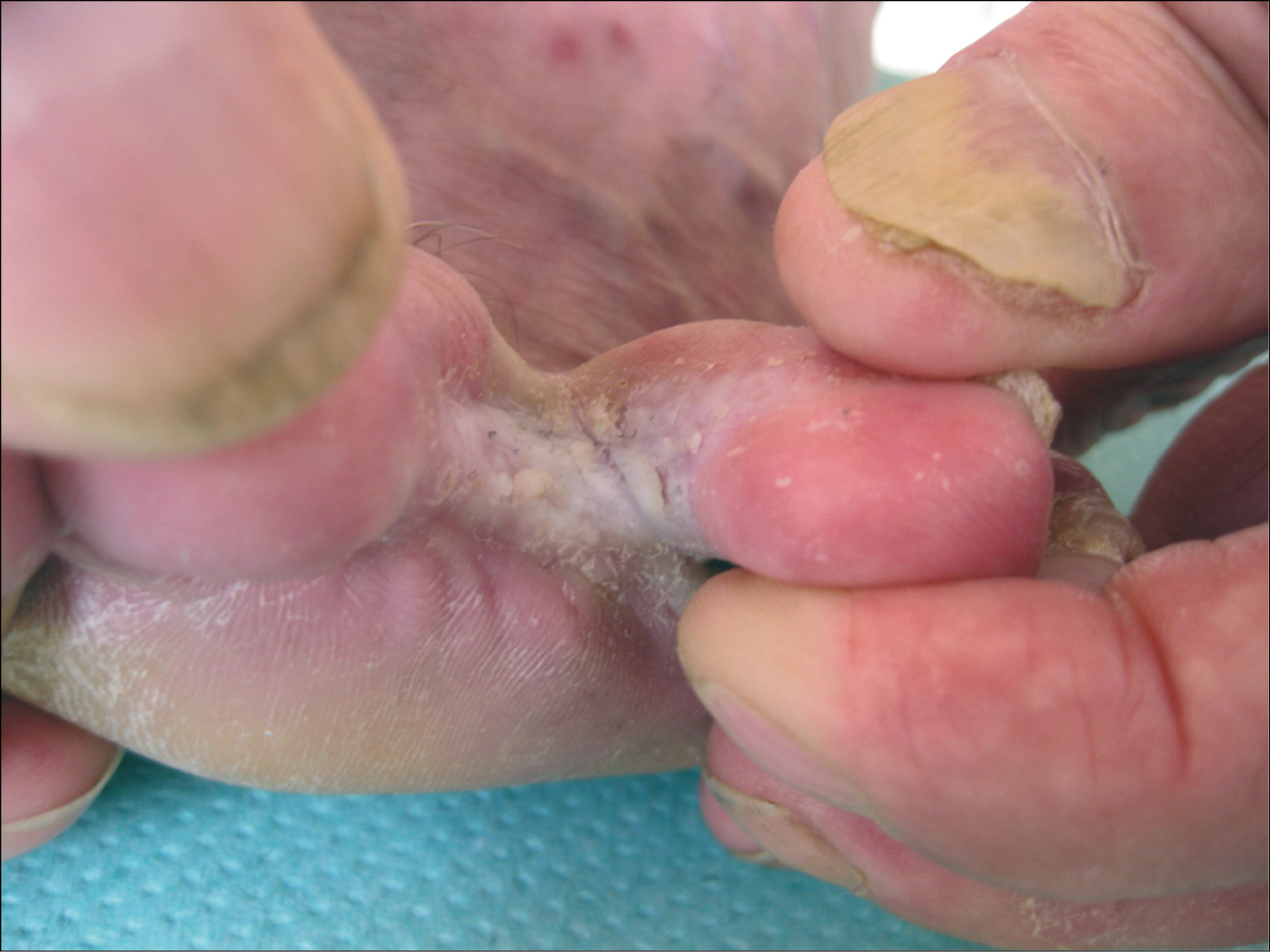 Figure 031_3294.  Interdigital foot mycosis. Maceration and scaling of the epidermis in the interdigital spaces. Secondary hand onychomycosis. Thickened, brittle nail plate of the thumb, keratinization of the nail bed, altered plate color (whitening). 