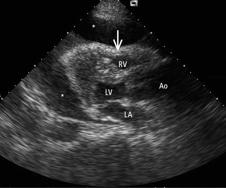 Figure 031_3425.  Transthoracic echocardiography (TTE), parasternal long-axis view: a large pericardial effusion (asterisks) and compression of the right-sided chambers of the heart (arrow). Ao, aorta; LA, left atrium; LV, left ventricle; RV, right ventricle. 