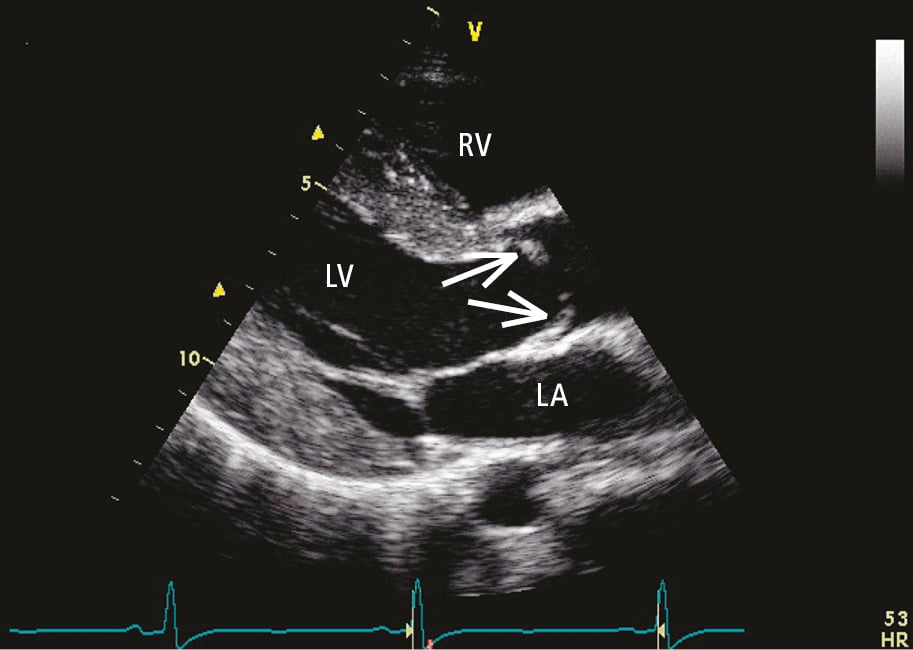 Figure 031_3549.  Transthoracic echocardiography (TTE) (parasternal long-axis view): slightly thickened (fibrotic) dome-shaped aortic valve leaflets with restricted motion during systole, left ventricular hypertrophy. LA, left atrium; LV, left ventricle; RV, right ventricle. 