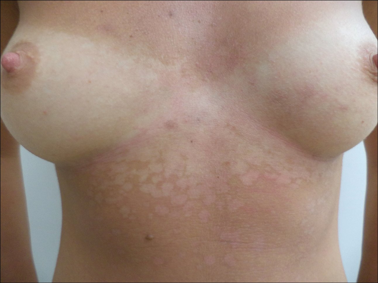 Figure 031_3616.  
Tinea versicolor. Numerous depigmented macules on the trunk, visible in summer following sun exposure. 