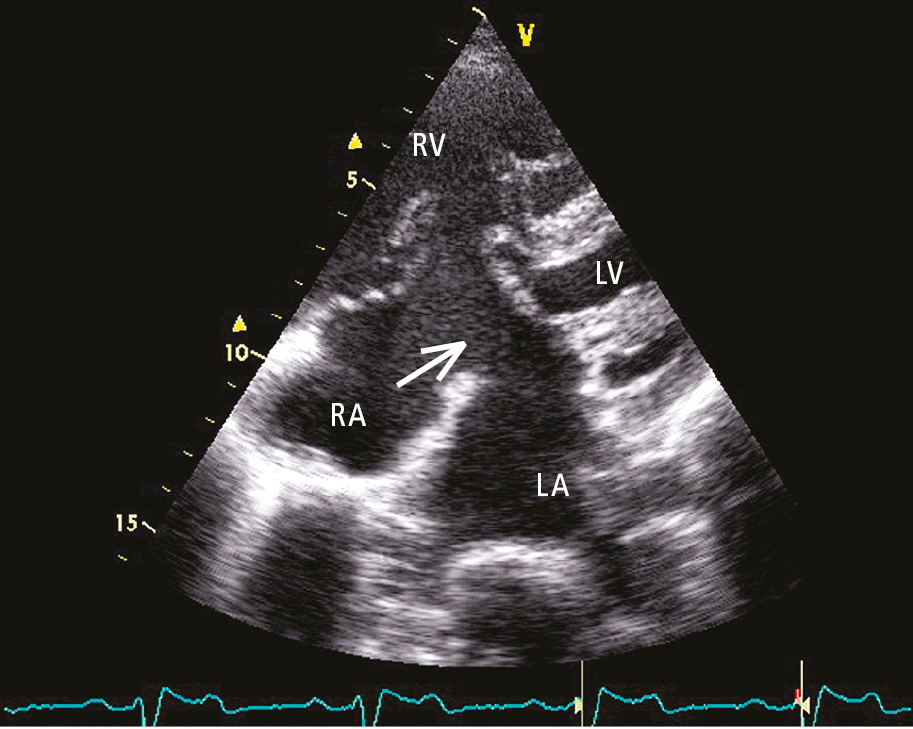 Figure 031_3619.  Transthoracic echocardiography (TTE) (4-chamber view): atrial septal defect (ASD) type I. Discontinuity of the interatrial septum (arrow). LA, left atrium; LV, left ventricle; RA, right atrium; RV, right ventricle. 