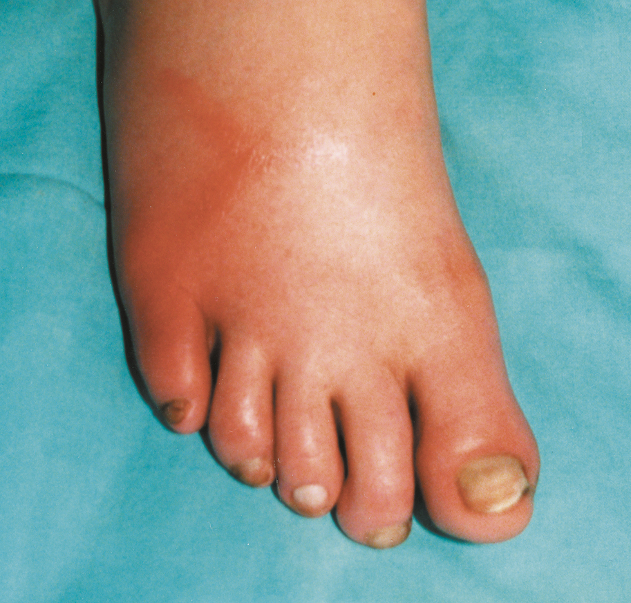 Figure 031_3635.  Thromboangiitis obliterans. Superficial phlebitis coexisting with features of limb ischemia.  Figure courtesy of Dr Leszek Masłowski.  