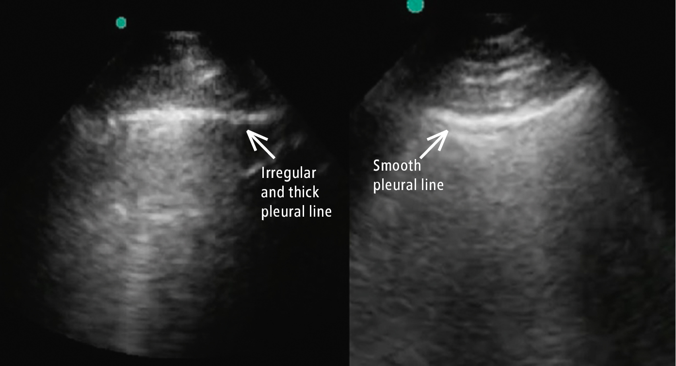Figure 031_3664.  Comparison between a smooth pleural line (cardiogenic pulmonary edema; right arrow) and a thick irregular pleural line (COVID-19; left arrow). Of note, there are B lines in both images. 