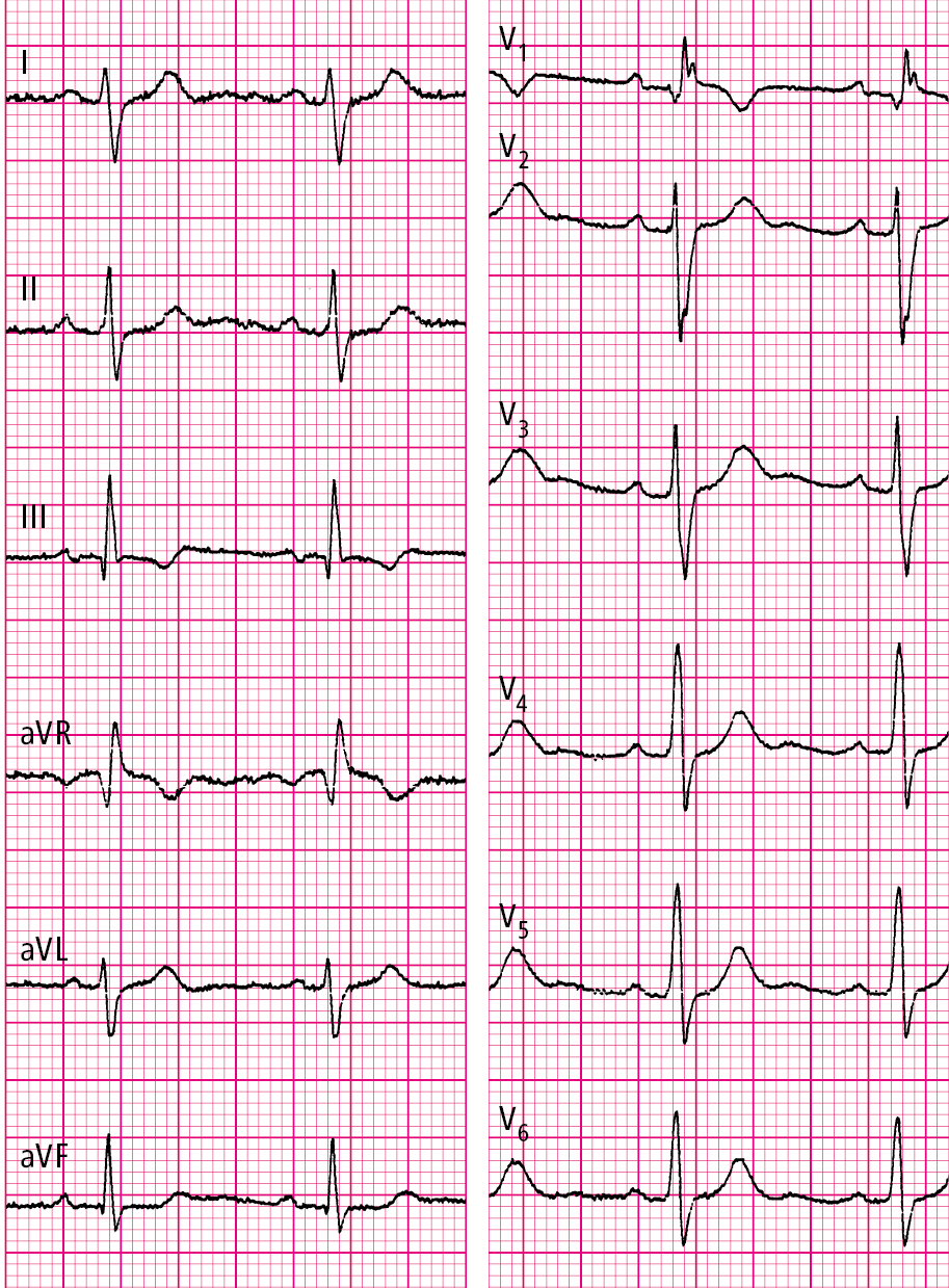 Figure 031_3712.  Electrocardiography (ECG) of a patient with atrial septal defect (ASD) type II: normal sinus rhythm, 77 beats/min, right axis deviation, incomplete right bundle branch block (RBBB), features of right ventricular hypertrophy. 