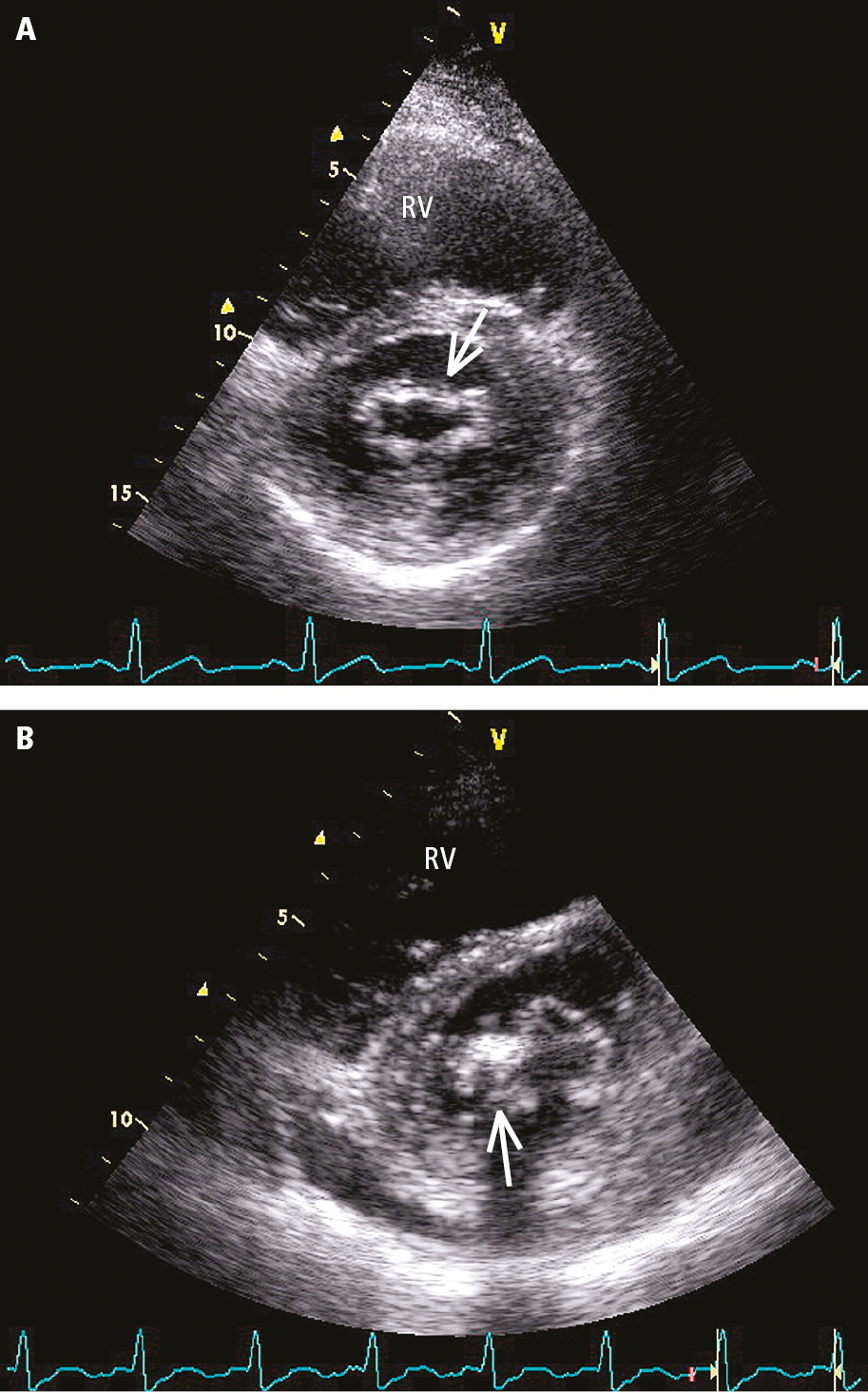 Figure 031_3861.  Transthoracic echocardiography (TTE) (parasternal short-axis view above the mitral valve orifice) of a patient with mitral valve stenosis:   A  , mild, evenly distributed fibrosis of mitral valve leaflets (arrow);   B  , localized thickening and fibrosis of mitral valve leaflets, calcification of the posterior commissure (arrow). RV, right ventricle.  