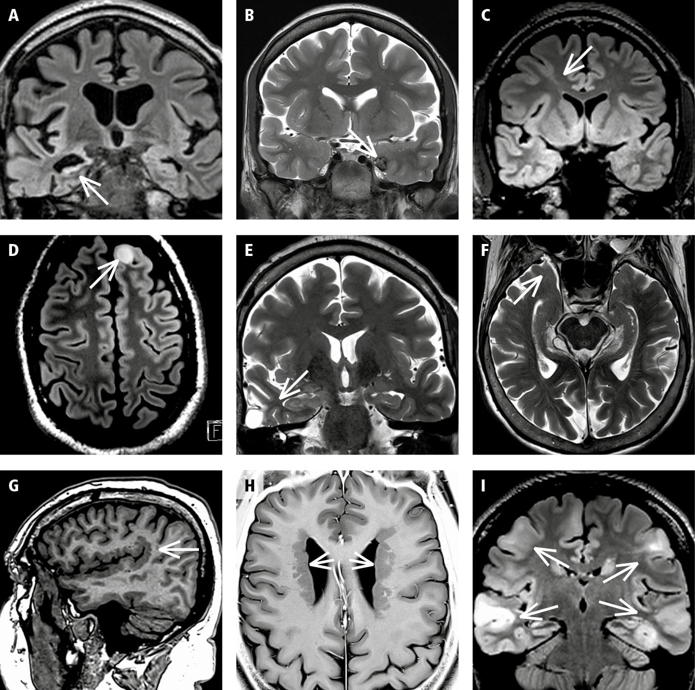 Figure 031_3950.  Selected classic structural lesions in epilepsy.  A , hippocampal sclerosis;  B , cavernoma;  C , focal cortical dysplasia;  D , neoplasia (benign tumor);  E , traumatic scar;  F , encephalocele;  G , polymicrogyria;  H , periventricular heterotopia;  I , tuberous sclerosis. 