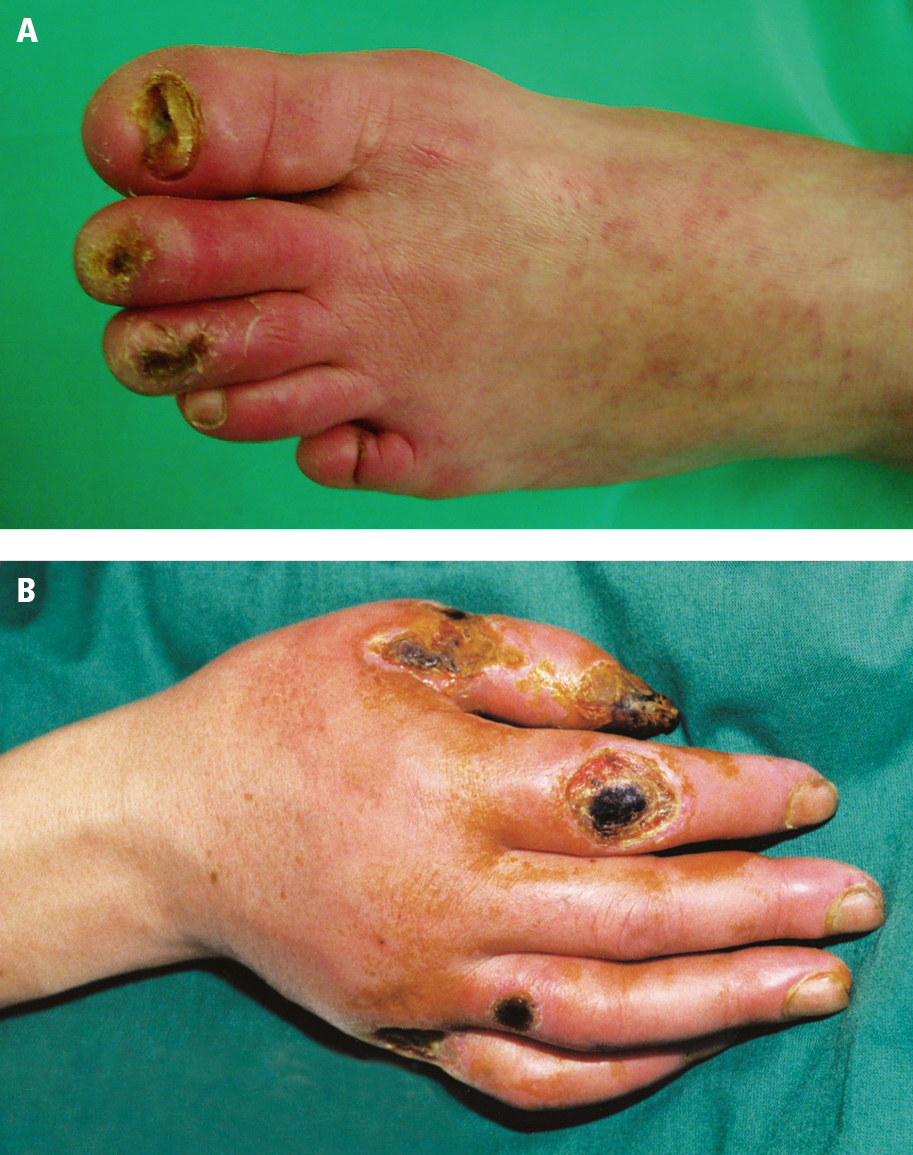 Figure 031_3961.  Cutaneous manifestations in thromboangiitis obliterans:  A , characteristic skin color and trophic toenail lesions;  B , hand ulcerations. 