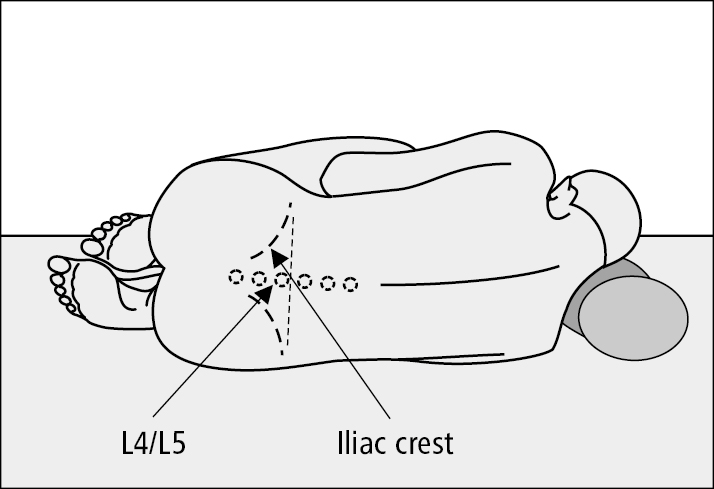 Figure 031_3_7306.  Appropriate patient positioning for lumbar puncture and location of the L4/L5 intercostal space. 