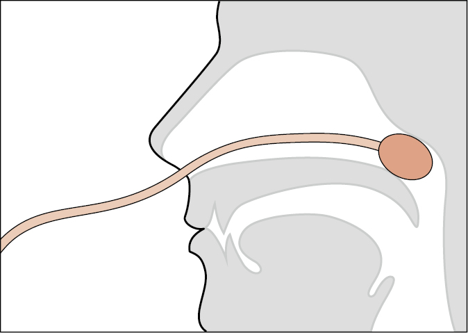 Figure 031_4037.  Nasal packing using a Foley catheter. 
