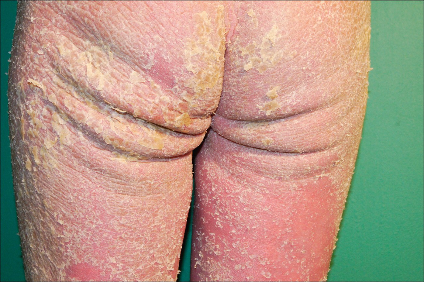 Figure 031_4087.  
Crusted scabies with visible erythroderma and pronounced hyperkeratosis. 