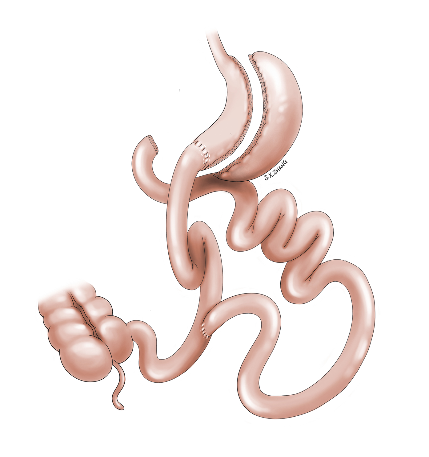 Figure 031_4090.  Biliopancreatic diversion with duodenal switch.  Illustration courtesy of Dr Shannon Zhang.  