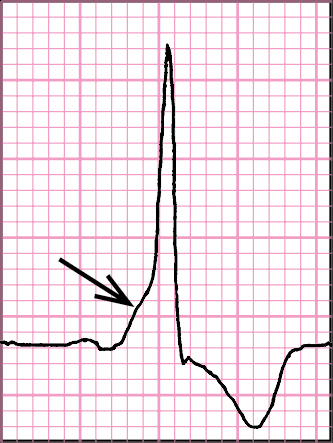 Figure 031_4093.  Preexcitation syndrome: short PR interval, delta wave on the ascending arm of the R wave (arrow), ST segment and T wave discordant with the QRS complex. 