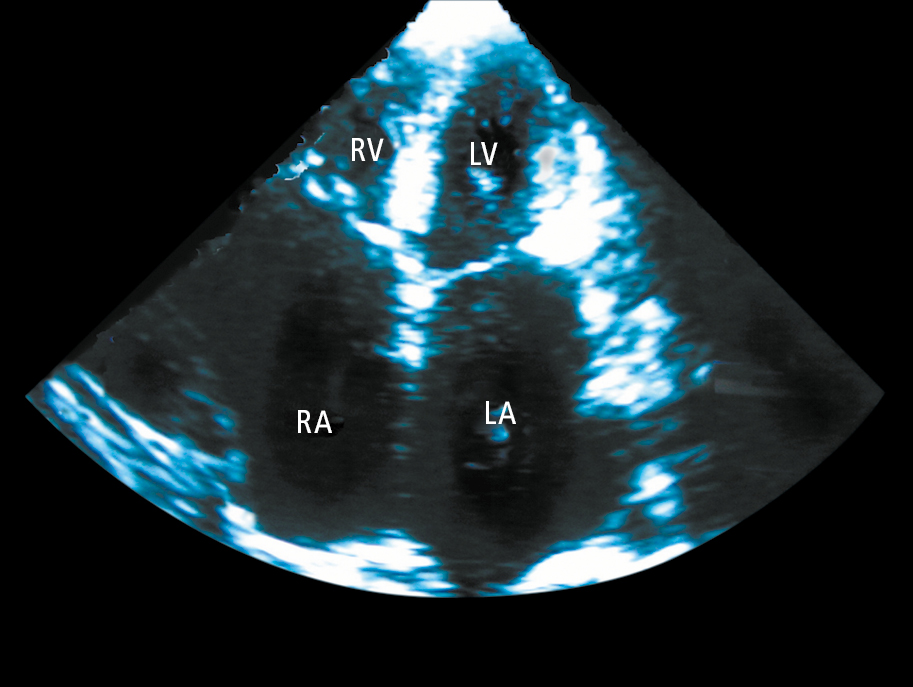 Figure 031_4106.  Echocardiography (apical 4-chamber view) of a patient with restrictive cardiomyopathy showing significant enlargement of both atriums (LA, left atrium; RA, right atrium). The left ventricle (LV) and right ventricle (RV) are normal sized. 
