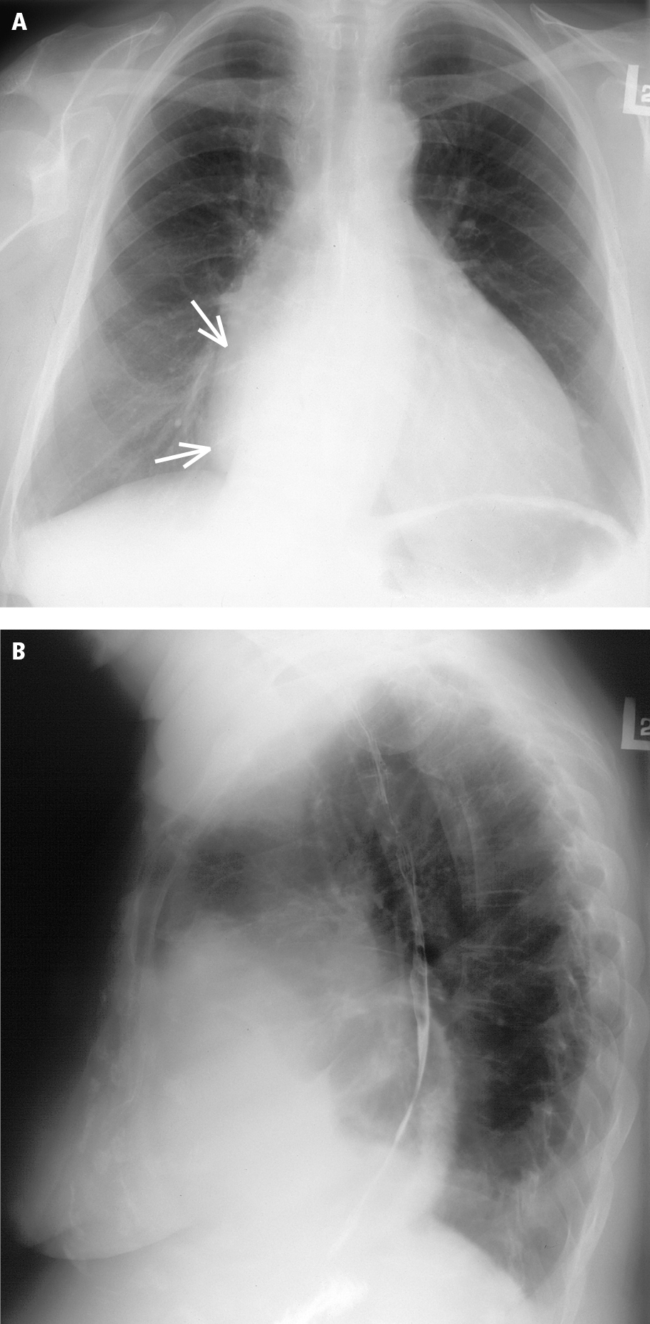 Figure 031_4131.  Chest radiography of a patient with combined tricuspid stenosis and regurgitation in the posteroanterior (PA) (  A  ) and lateral (  B  ) views: cardiomegaly, prominent right atrium (arrows); decreased pulmonary vascularity suggests reduced right ventricular output. 