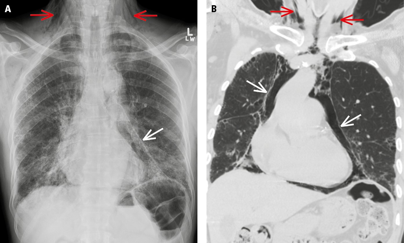 Figure 031_4137.  Posteroanterior (PA) chest radiograph ( A ) and computed tomography scan ( B ) demonstrate pneumomediastinum (white arrows) and subcutaneous emphysema (red arrows). 