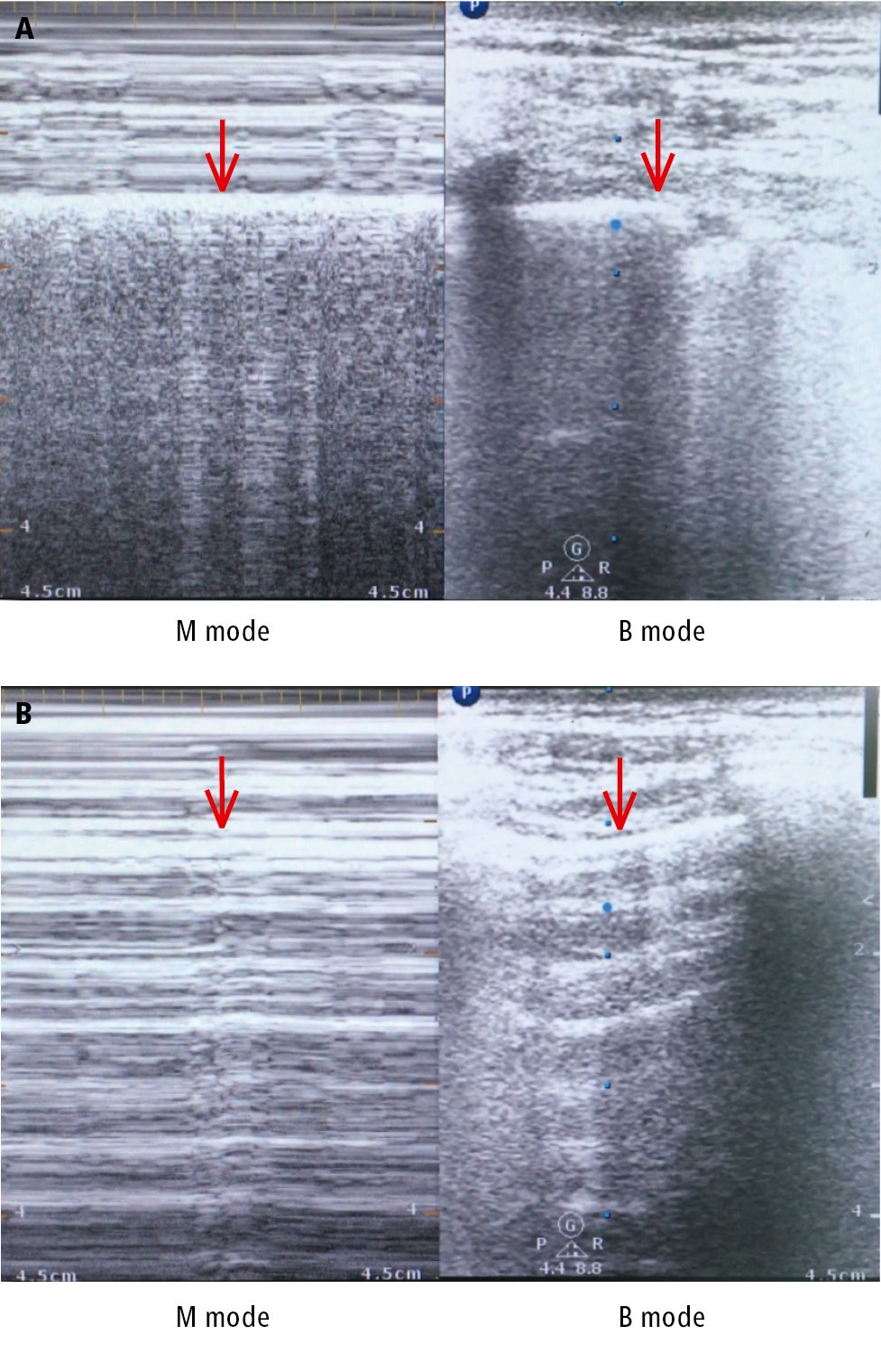 Figure 031_4211.  Pleural ultrasonography demonstrates the “seashore sign” in a healthy person ( A ) and the “barcode sign” in pneumothorax ( B ). Pleural lines are identified by arrows. 