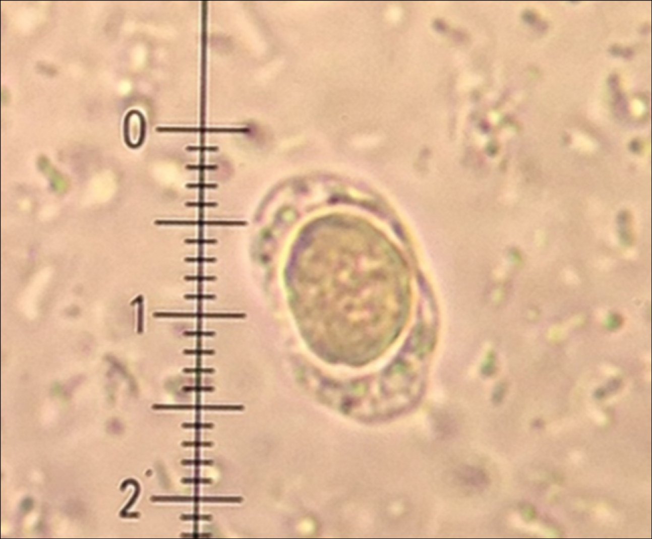 Figure 031_4461.  
Vacuolar form of  Blastocystis   hominis.  