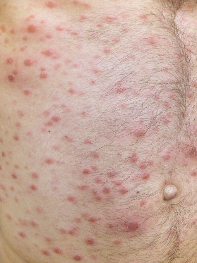 Figure 031_4518.  Recurrent maculopapular rash. 