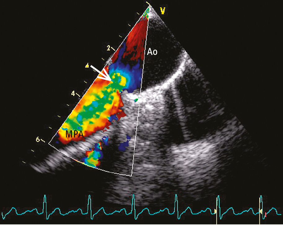 Figure 031_4821.  Transesophageal echocardiography (TEE) with color Doppler in a patient with patent ductus arteriosus (PDA): a left-to-right shunt (arrow). Ao, aorta; MPA, main pulmonary artery. 