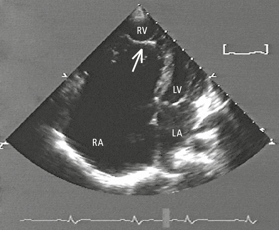 Figure 031_4861.  Transthoracic echocardiography (TTE) of a patient with Ebstein anomaly: significant displacement of the septal leaflet into the right ventricle (arrow). LA, left atrium; RA, right atrium; RV, right ventricle. 