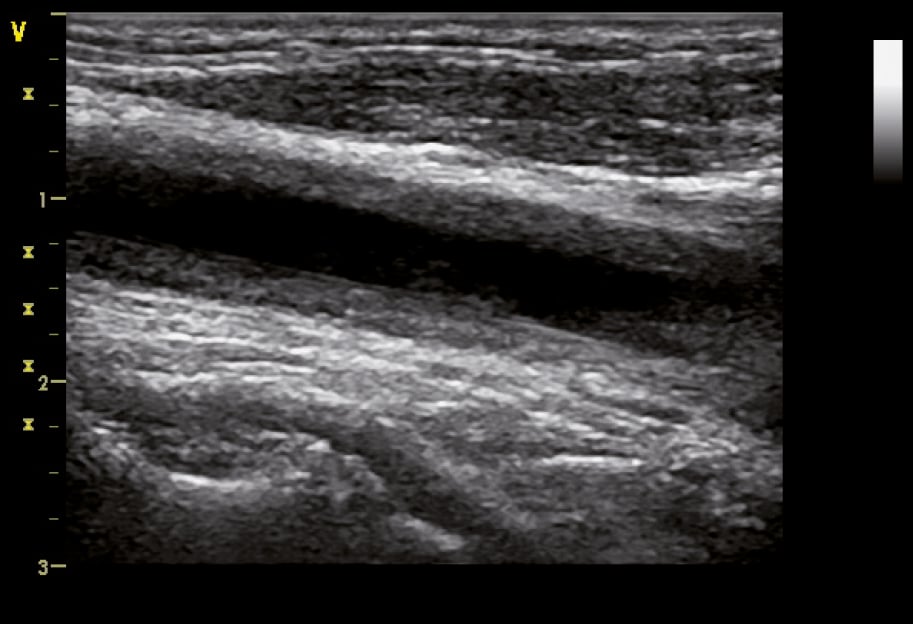 Figure 031_4969.  B-mode ultrasonography of the common carotid artery in a 32-year-old woman with Takayasu arteritis showing homogenous hypoechoic wall thickening (wall echogenicity increases in late disease) clearly separated from the arterial lumen, which is typical of vasculitis.  Figure courtesy of Dr Leszek Masłowski.  