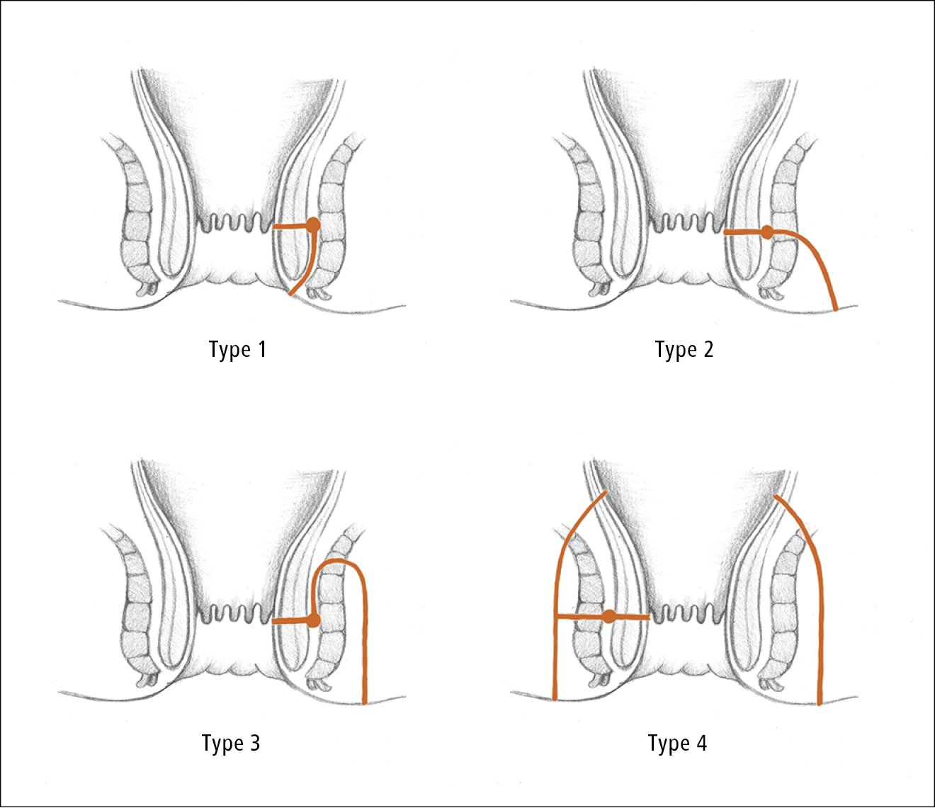 Figure 031_4_7088.  Types of fistula in ano.  Type 1 , intersphincteric fistula.  Type 2 , transsphincteric fistula.  Type 3 , suprasphincteric fistula.  Type 4 , extrasphincteric fistula.  Illustration courtesy of Dr Shannon Zhang.  