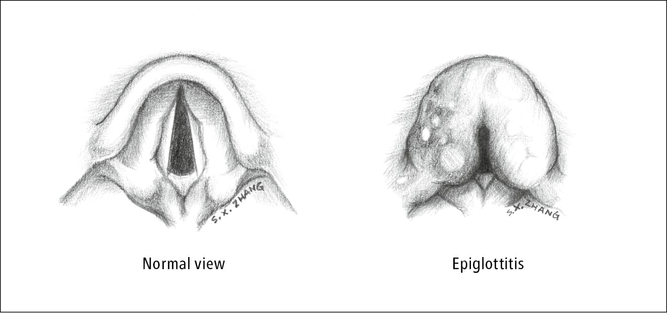 Figure 031_4_7708.  Epiglottitis.  Illustration courtesy of Dr Shannon Zhang.  
