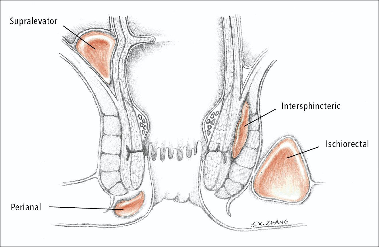 Figure 031_4_9997.  Location of abscesses.  Illustration courtesy of Dr Shannon Zhang.  
