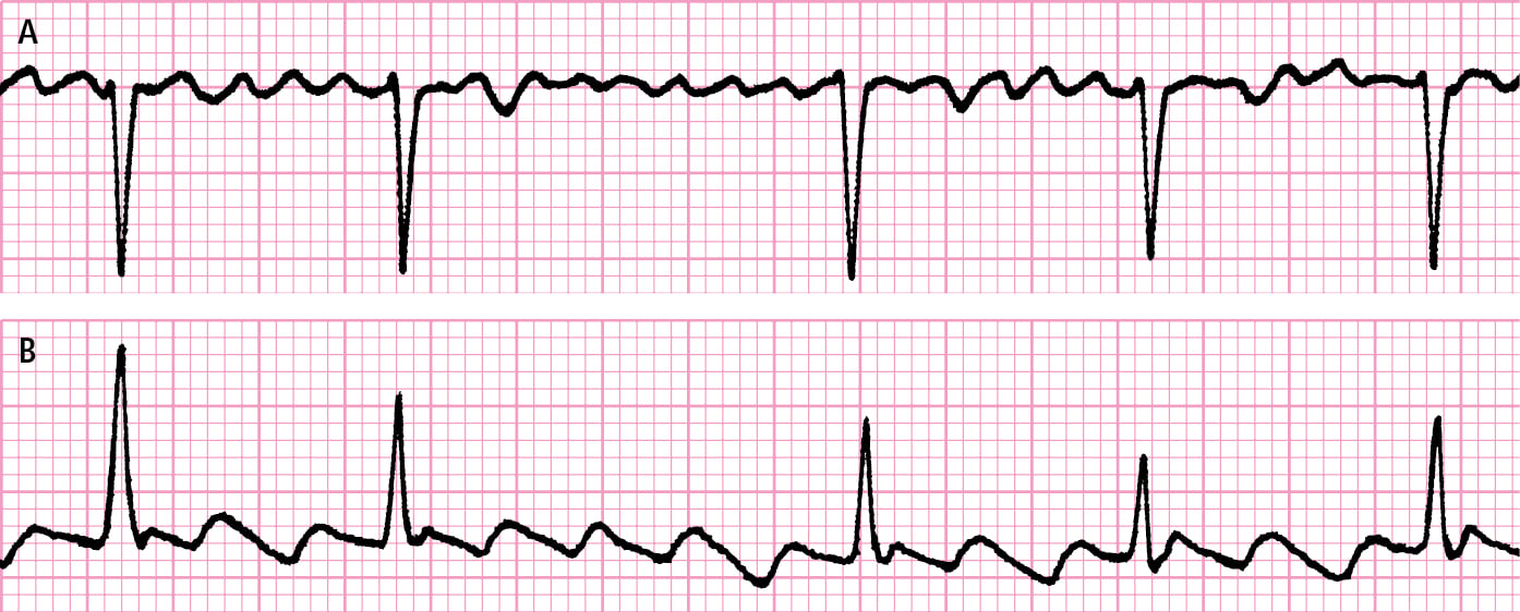 Figure 031_5035.  Atrial fibrillation and atrial flutter.  A , polymorphic F waves replacing P waves during atrial fibrillation.  B , monomorphic biphasic F waves replacing P waves during atrial flutter. 