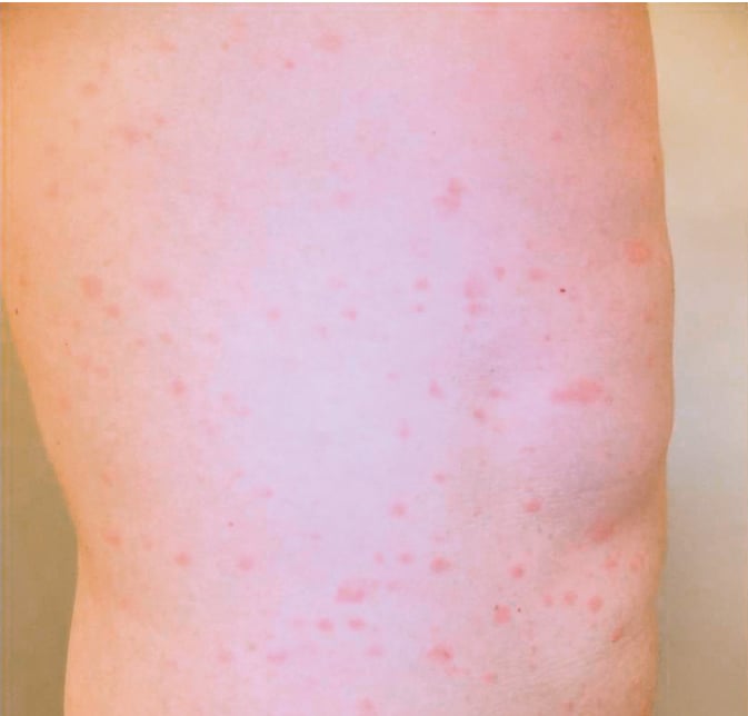 Figure 031_5307.  Macular rash in early secondary syphilis. 