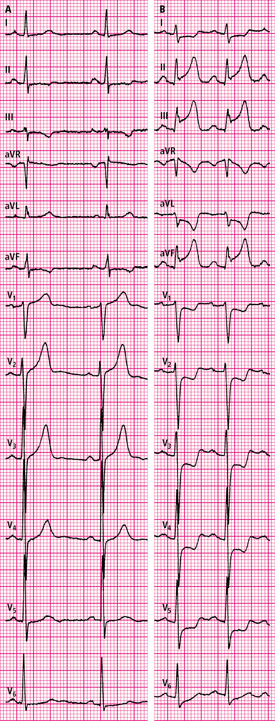 Figure 031_5336.  Electrocardiography (ECG) of a patient with vasospastic angina in a pain-free state ( A ) and during a pain episode ( B ).  Figure courtesy of Dr Tomasz Pasierski.  