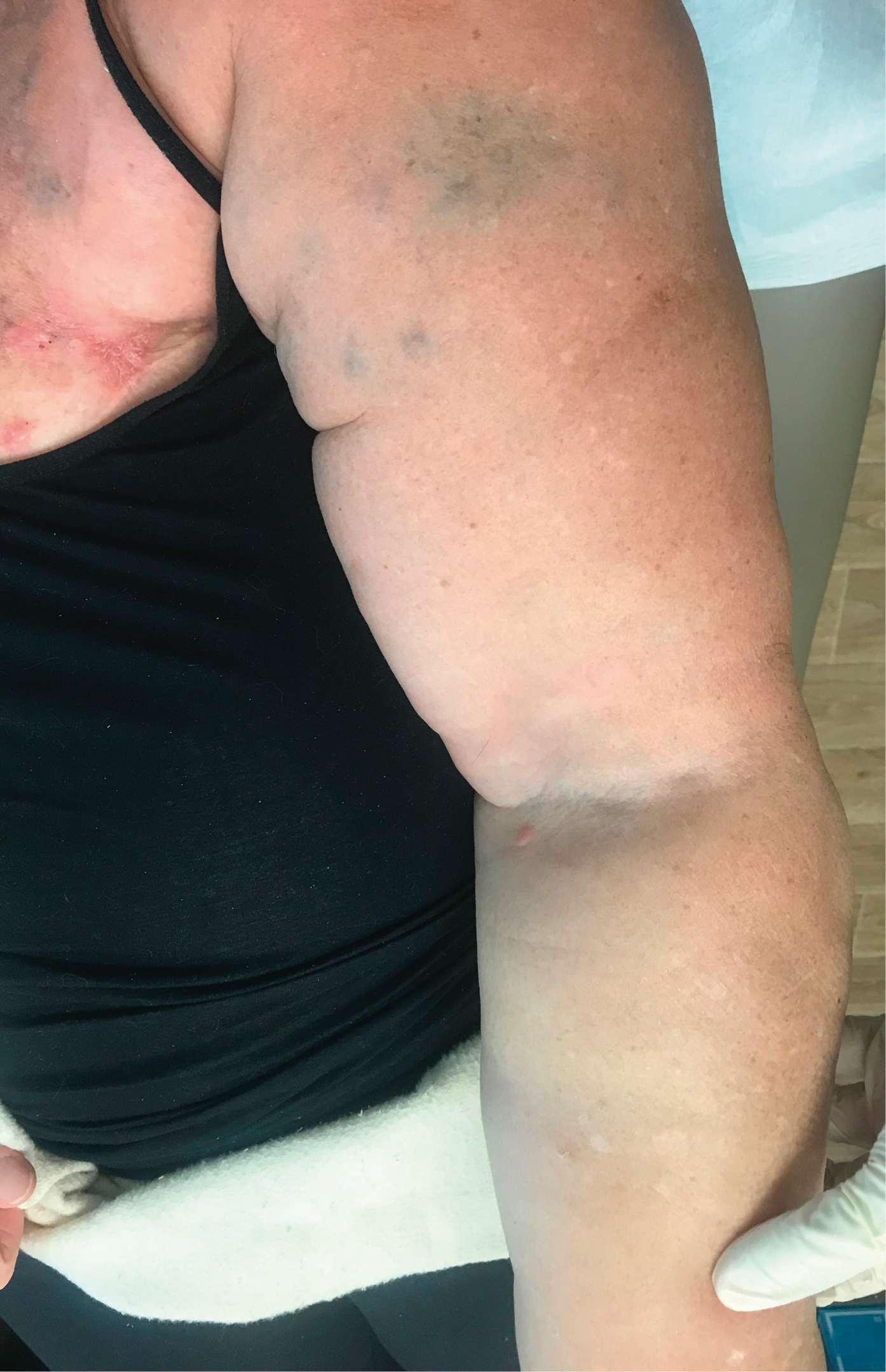 Figure 031_5384.  Lymphedema of the left arm 7 years after left breast cancer mastectomy and left axillary lymph node dissection. 