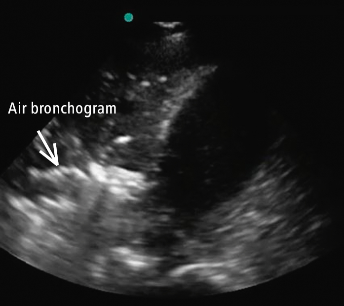 Figure 031_5525.  Translobar consolidation of the right lower lobe with hepatization of the lung, in addition to the finding of dynamic air bronchogram (refer to Video 4, which demonstrates dynamic air bronchogram in the area of the arrow). 