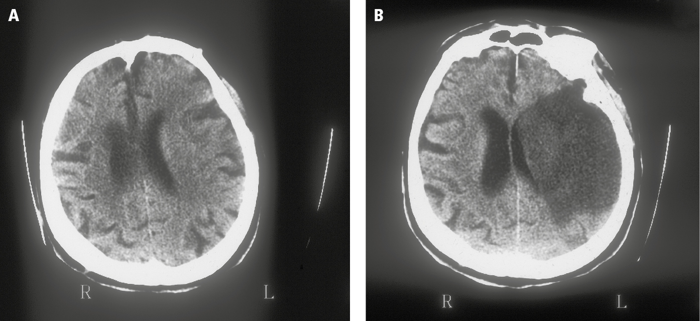 Figure 031_5638.  Computed tomography (CT) of ischemic stroke:  A , left hemispheric edema with compression of the lateral ventricle, a hypodense area of the middle cerebral artery (MCA) territory, 3 hours following the onset of symptoms;  B , a large ischemic lesion with midline shift, 72 hours following the onset. 