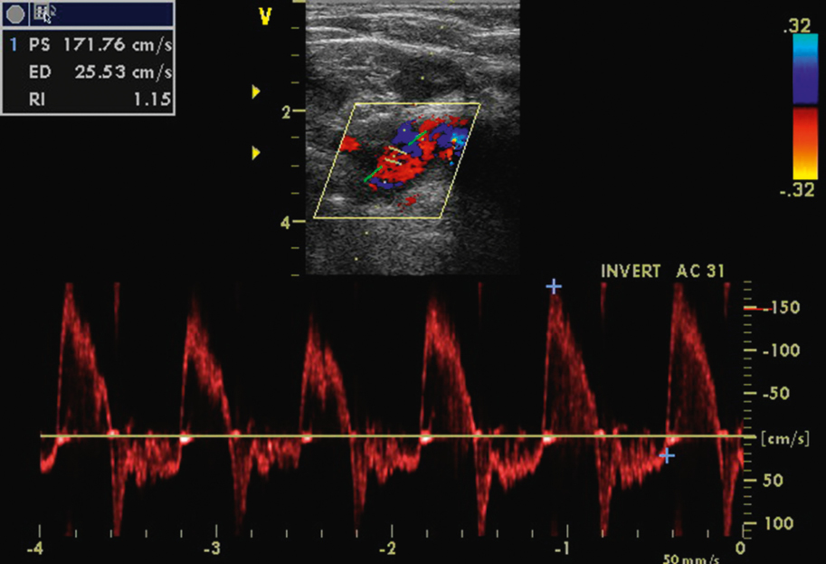 Figure 031_5745.  Abnormal spectrum of blood flow velocity in the subclavian artery in a woman with Takayasu arteritis and severe aortic regurgitation. Note the long retrograde flow phase (absent in patients without regurgitation).  Figure courtesy of Dr Marek Krzanowski.  