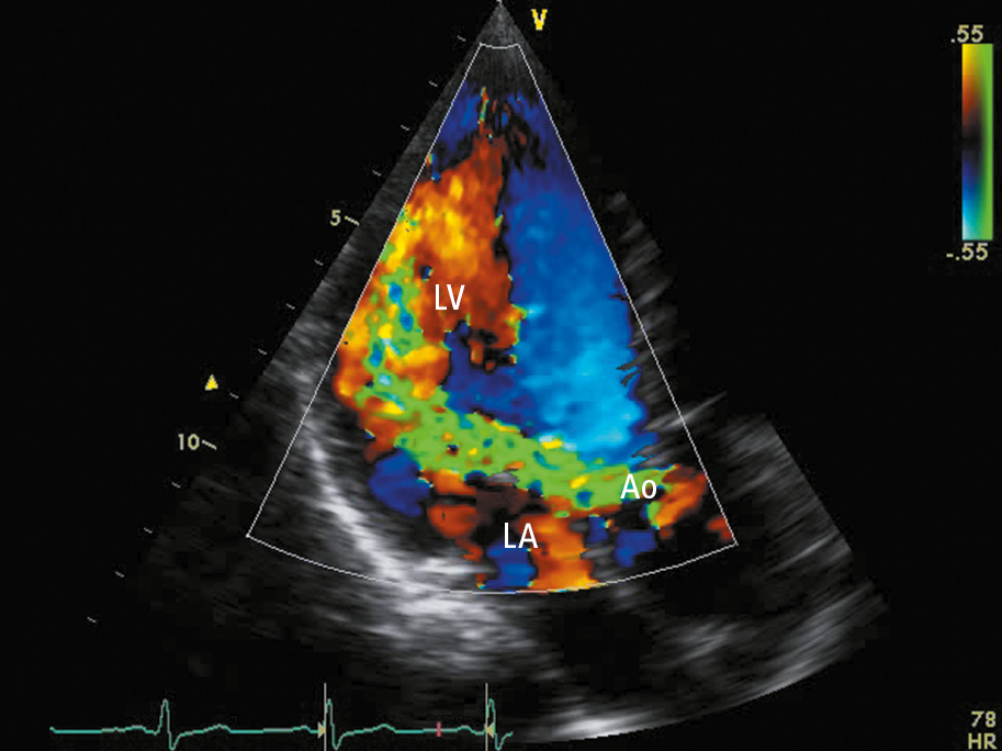 Figure 031_5820.  Transthoracic echocardiography (TTE) (apical long-axis view): severe aortic regurgitation (regurgitation jet marked in green). Ao, aorta; LA, left atrium; LV, left ventricle.  