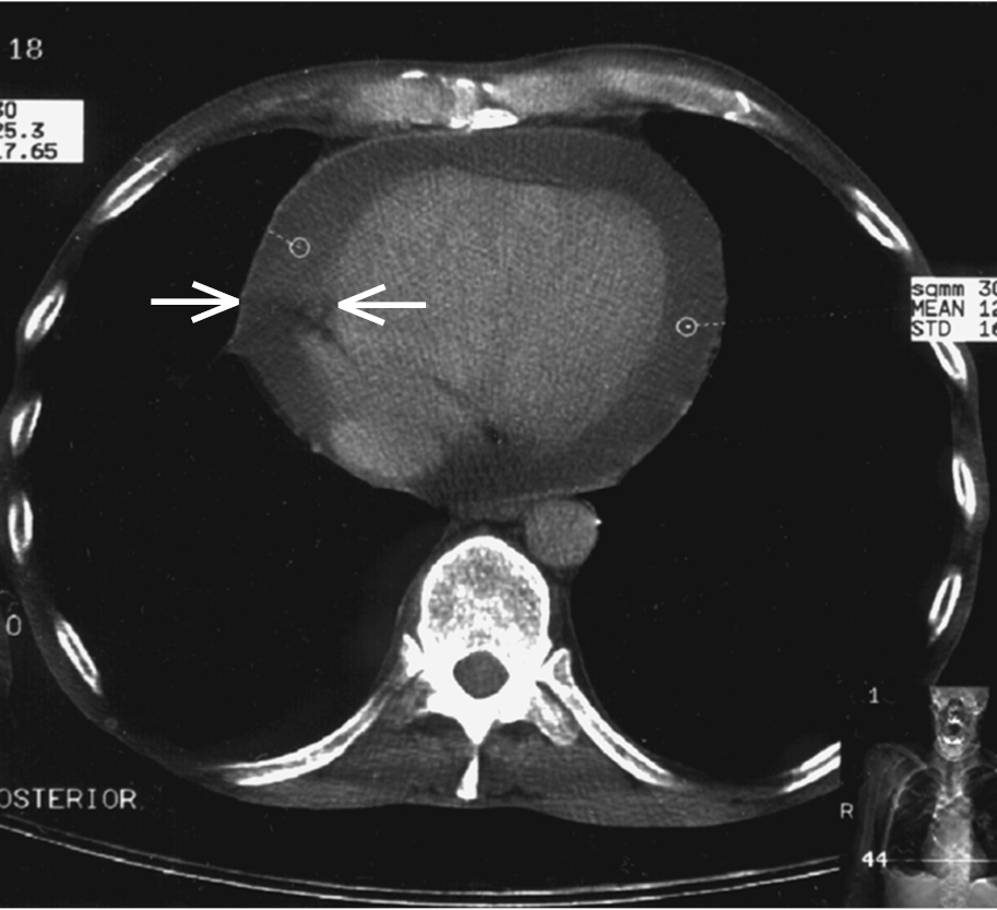 Figure 031_5844.  Chest computed tomography (CT): pericardial effusion (arrows) with a fluid layer up to 18 mm. 