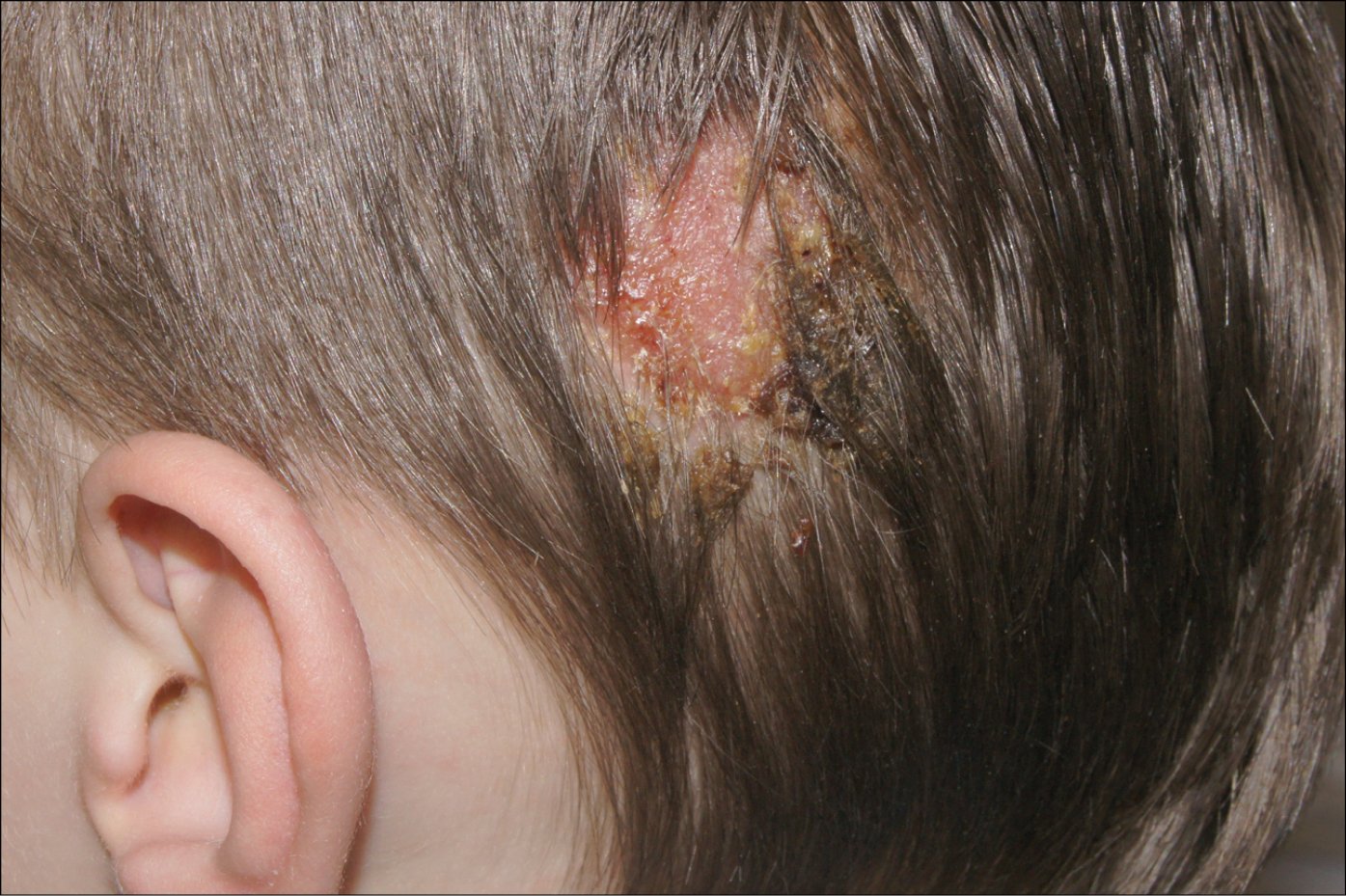 Figure 031_5902. Tinea capitis with a significant inflammatory