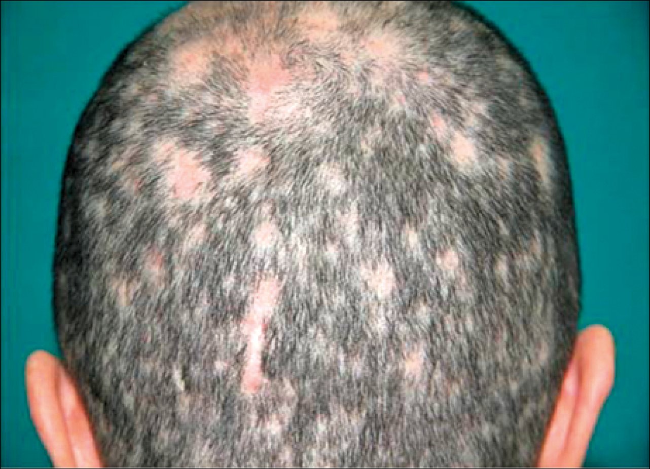 Figure 031_5960.  Focal alopecia in recurrent secondary syphilis. 