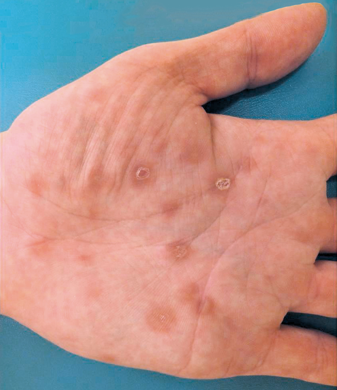 Figure 031_5986.  Maculopapular lesions in secondary syphilis. Peripheral desquamation (the so-called Biett collarette) can be observed. 