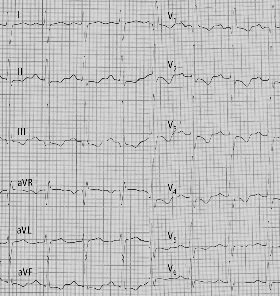 Figure 031_6134.  Electrocardiography (ECG) of a patient with idiopathic pulmonary hypertension: right axis deviation, P pulmonale, right bundle branch block, features of right ventricular hypertrophy and right ventricular strain.  Figure courtesy of Dr Adam Torbicki.  