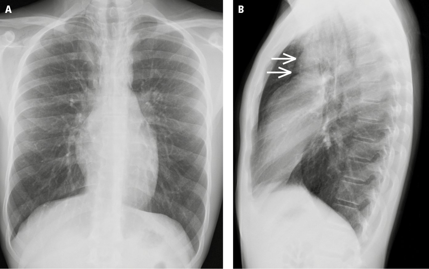 Figure 031_6138.  A patient with subtle pneumomediastinum, hardly seen on posteroanterior (PA) chest radiographs ( A ), that is identified on the basis of a thin radiolucent line highlighting the contour of the aorta (arrows) on the left lateral view ( B ). This finding represents air in the mediastinal soft tissue. 