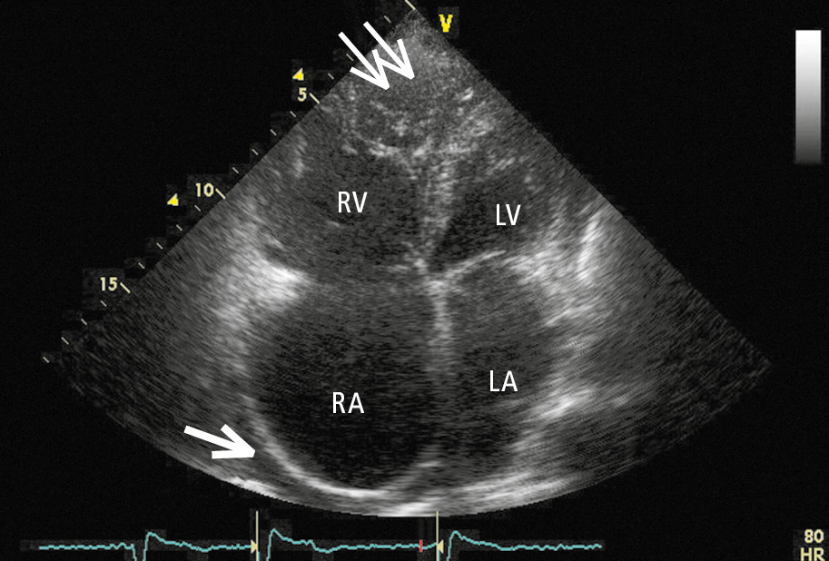Figure 031_6162.  Transthoracic echocardiography (TTE) of a patient with arrhythmogenic right ventricular cardiomyopathy (ARVC). A modified apical 4-chamber view showing diffuse right ventricular injury, ample trabeculation at the apex (thin arrows), significant right atrial dilatation, and separation of pericardial layers due to pericardial fluid accumulating behind the right atrium (thick arrow). LA, left atrium; LV, left ventricle; RA, right atrium; RV, right ventricle.  Figure courtesy of Dr Marek Konka.  