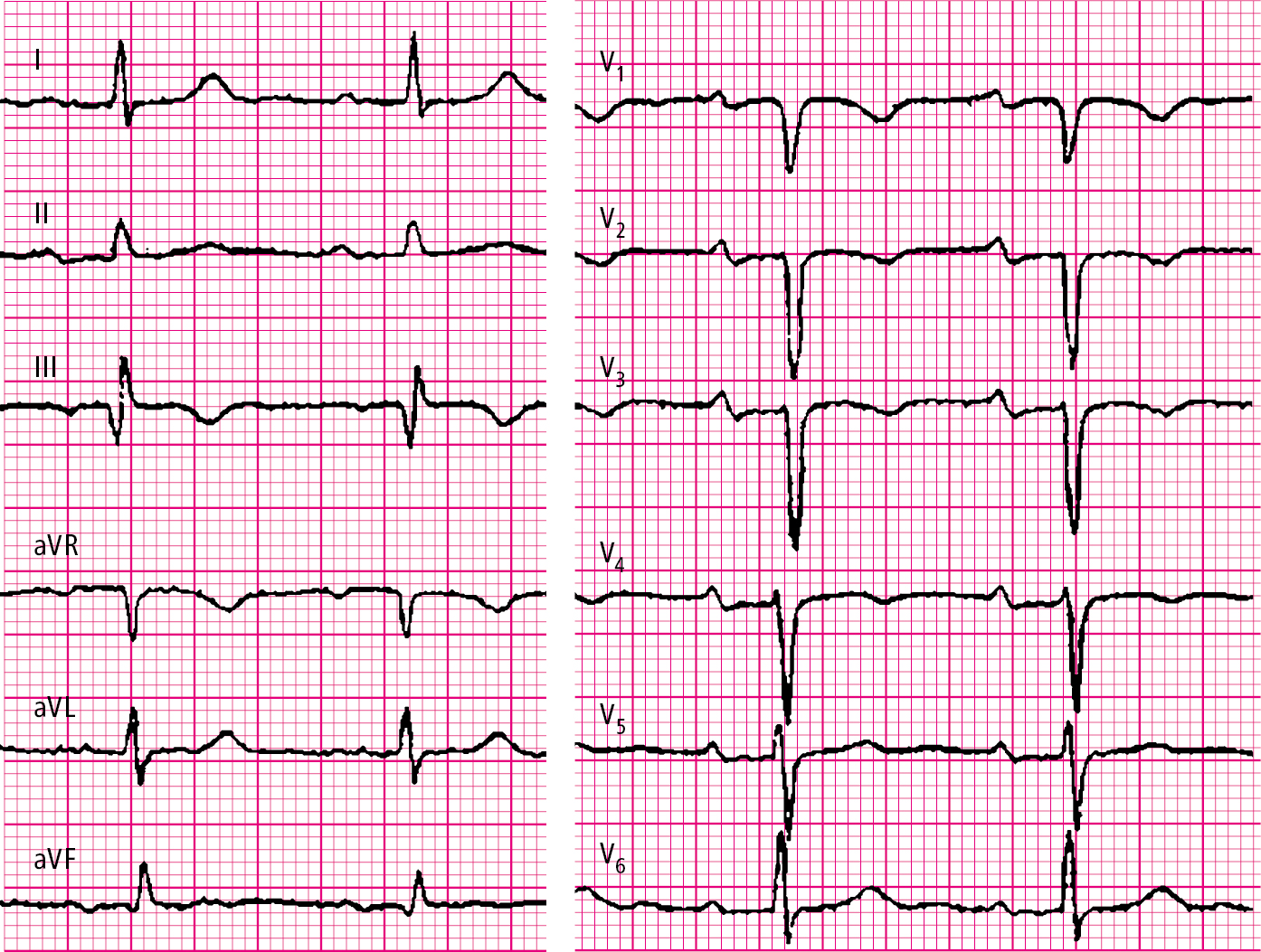 Figure 031_6200.  Electrocardiography (ECG) of a patient with intermediate-risk pulmonary embolism: SIQIII syndrome, inverted T waves in right precordial leads V  1   through V  4  ; PR interval prolonged to 220 ms. 