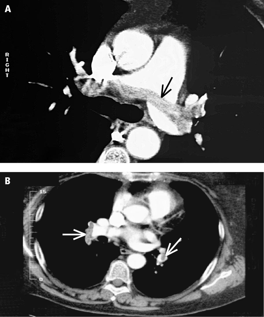 Figure 031_6306.  Computed tomography angiography (CTA) of pulmonary embolism:   A  , a saddle embolus (arrow);   B  , emboli in peripheral branches (arrows). 